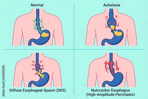 Esophageal motility disorders illustration comparing normal swallowing, achalasia, diffuse esophageal spasm, and nutcracker esophagus
