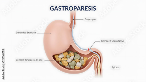 Medical illustration showing human stomach with gastroparesis and food