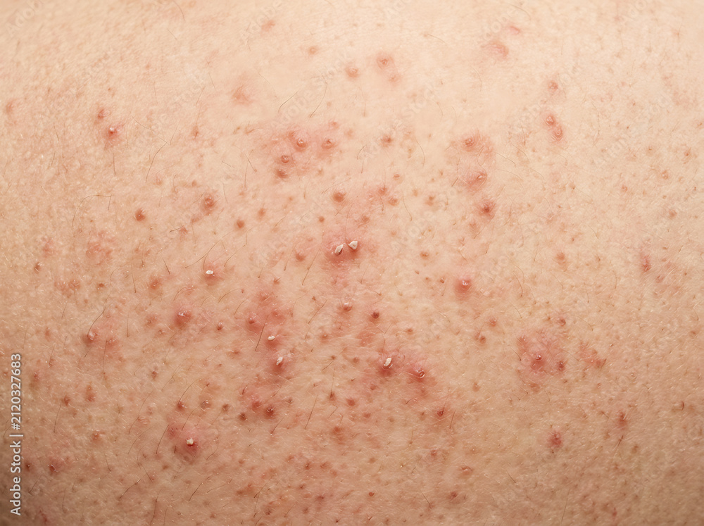 Fototapeta premium Close-up of human skin with uneven, bumpy texture and reddish spots