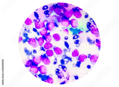 Blood cancer cells acute myeloid leukemia (AML) analyzed by light microscope..