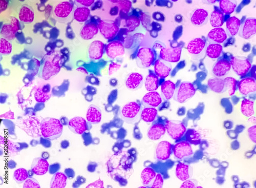 Blood cancer cells acute myeloid leukemia (AML) analyzed by light microscope..