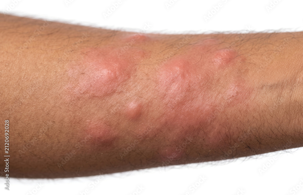Fototapeta premium Close up of severe hives urticaria and allergic reaction red welts on human arm.