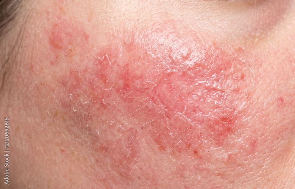 Fototapeta premium Extreme macro close up of severe contact dermatitis damaged skin barrier and red weeping rash on face.