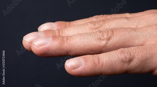 Close up of human fingers demonstrating mild clubbing nail deformation