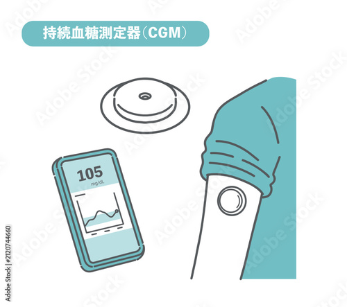 持続血糖測定器（CGM）のイラストセット