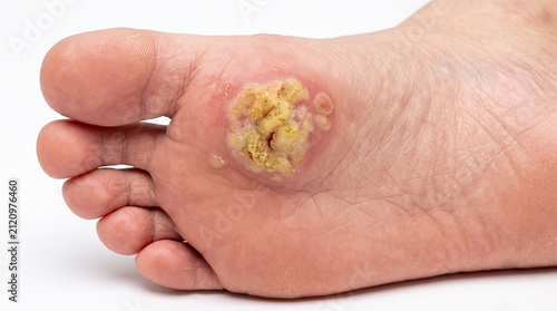 Bild auf Leinwand Infected Plantar Wart with Pus and Redness on the Ball of a Foot - Suppurative V