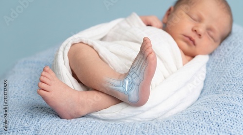 Medical illustration of a sleeping newborn infant with a digital X-ray overlay showing foot and ankle bone structure
