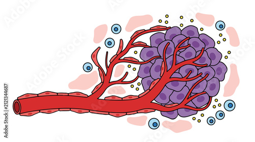 Cancer Tumor with Blood Vessels and Cells Vector Illustration