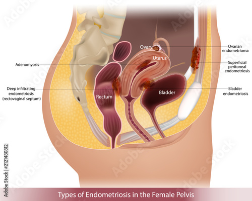 Medical illustration of different types of endometriosis in the female pelvis, including adenomyosis, ovarian endometrioma, superficial peritoneal endometriosis, deep infiltrating endometriosis of the