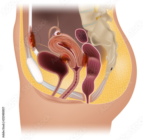 Medical illustration of different types of endometriosis in the female pelvis, including adenomyosis, ovarian endometrioma, superficial peritoneal endometriosis, deep infiltrating endometriosis of the