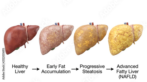 Medical illustration showing the progression of nonalcoholic fatty liver disease from healthy to advanced steatosis