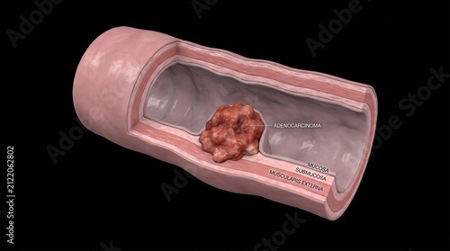 Human Colorectal Cancer Colon Adenocarcinoma Model