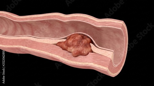Human Colorectal Cancer Colon Adenocarcinoma Model