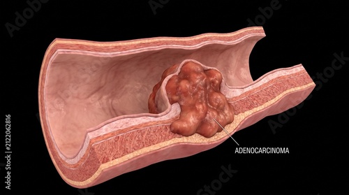 Human Colorectal Cancer Colon Adenocarcinoma Model