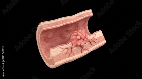 Human Colorectal Cancer Colon Adenocarcinoma Model