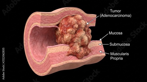 Human Colorectal Cancer Colon Adenocarcinoma Model
