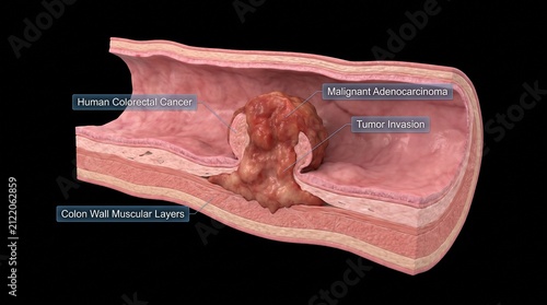 Human Colorectal Cancer Colon Adenocarcinoma Model