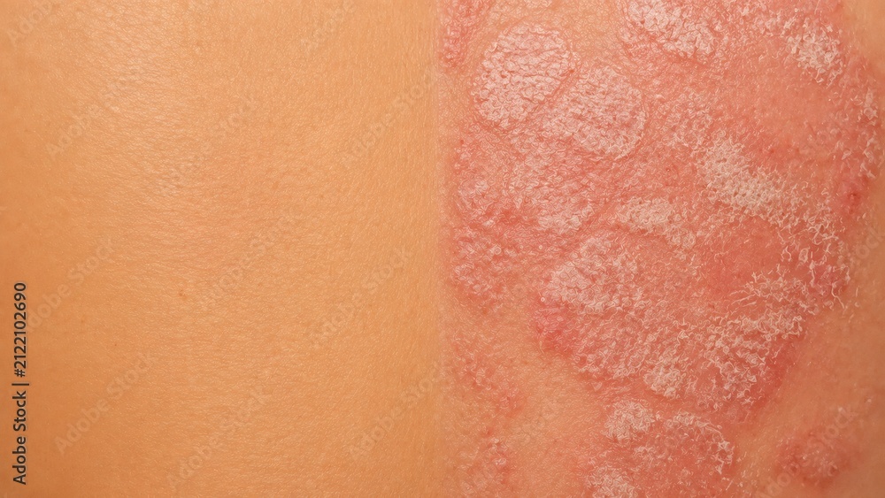 Fototapeta premium Skin with psoriasis showing patches and healthy skin on background 