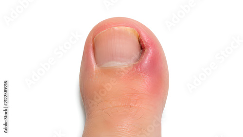 Ingrown toenail with inflamed nail fold in photorealistic medical education close-up on white clinical background for podiatry, healthcare communication, and patient education design use