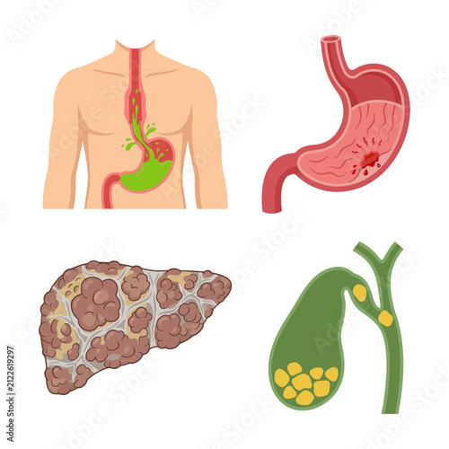 Картината върху платно Medical Illustration of Human Digestive System Organs Showing Pathological Condi