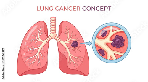 Detailed medical illustration of lung cancer concept with a magnified view of malignant tumor cells