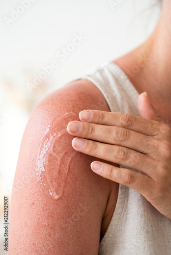 Person applying soothing aloe vera gel on red sunburnt shoulder for skin care treatment