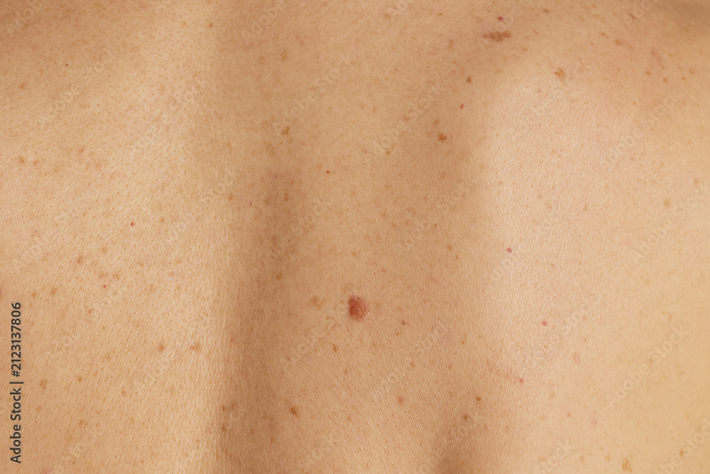 Fototapeta premium A detailed shot of a womans upper back showing natural skin texture, numerous freckles, sunspots, and a central mole, highlighting dermatology and skin health awareness.
