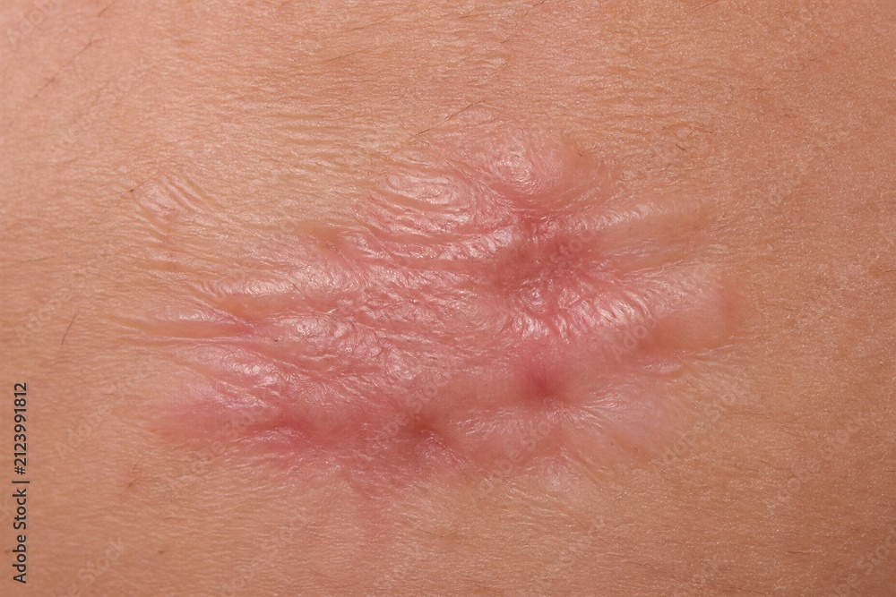 Fototapeta premium Skin scar healed raised area close up on flesh surface medical