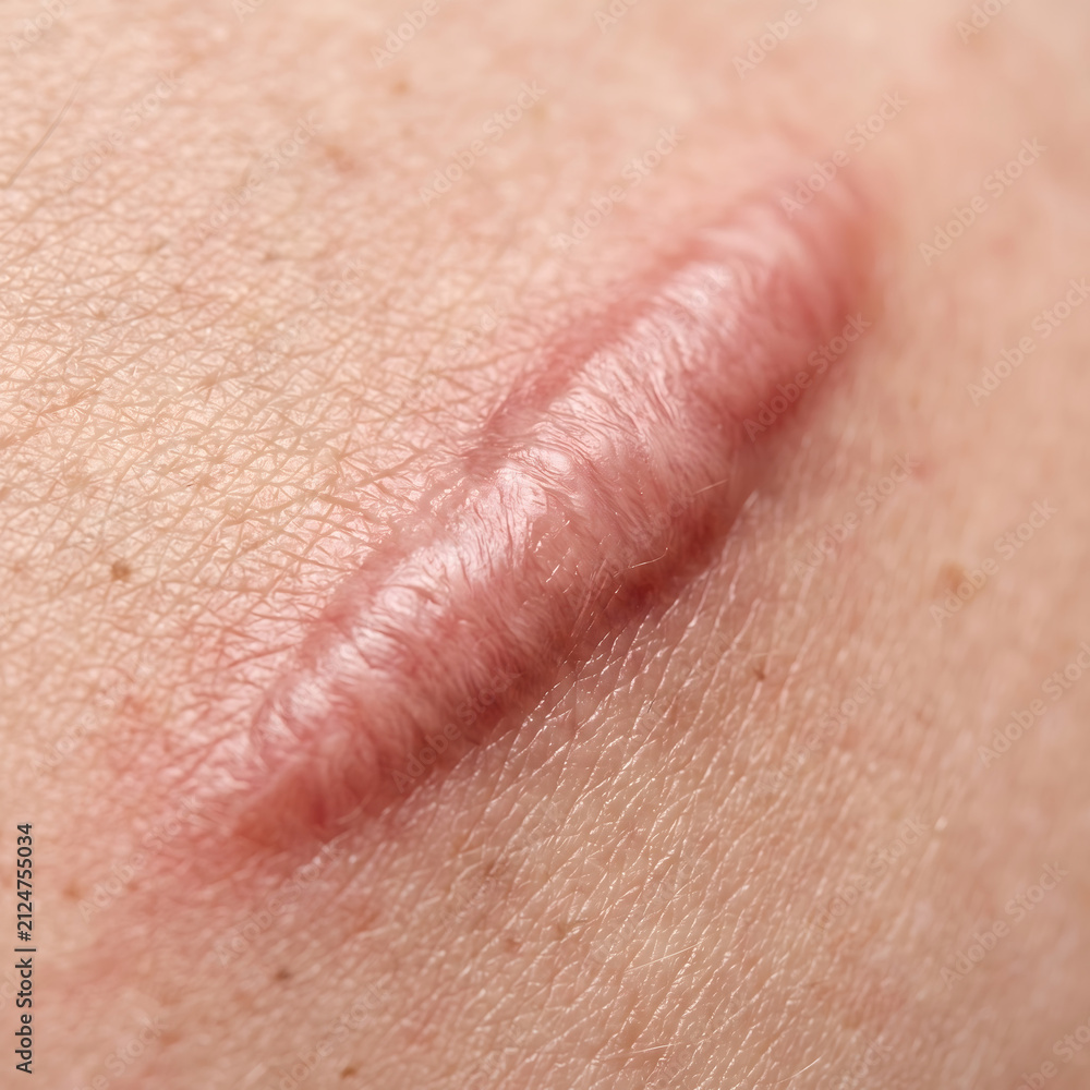 Fototapeta premium Scar tissue forms a raised pink ridge on the human skin surface following a previous injury.