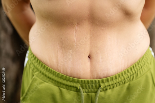 Foto Close up of female abdomen with stretch marks and surgical scar on skin