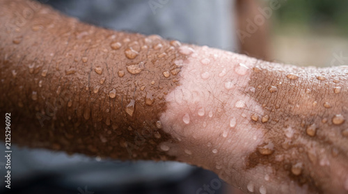 Close up shot of human arm displaying vitiligo skin condition with water droplets visible on surface showing contrast of light and dark tones.