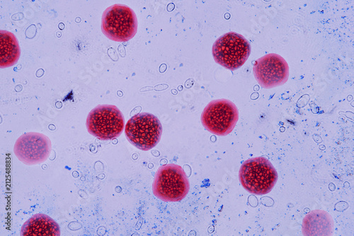 Cuadro en lienzo Micrograph of Cyclospora cayetanensis oocysts in a stool sample, stained magenta using modified acid-fast stain