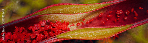 Blood vessel obstruction caused by fatty cholesterol buildup demonstrating reduced circulation, vascular inflammation, and increased risk of coronary artery disease and stroke. 3D Rendering