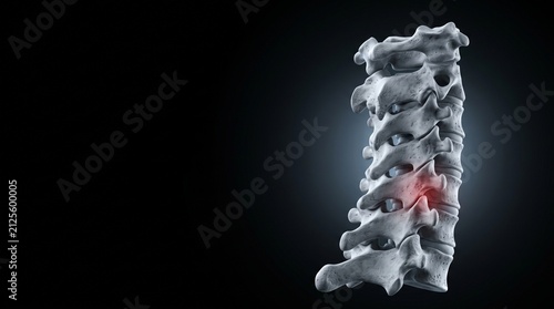 Human Cervical Spine Pain