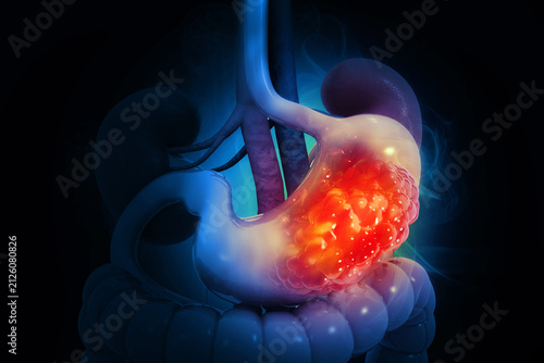 stomach cancer or gastric cancer with organs and tumors. cancerous cells 3d illustration