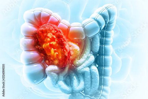 Medical illustration of Colorectal Cancer. large intestine with a malignant tumor growth disease of the digestive system. 3d illustration