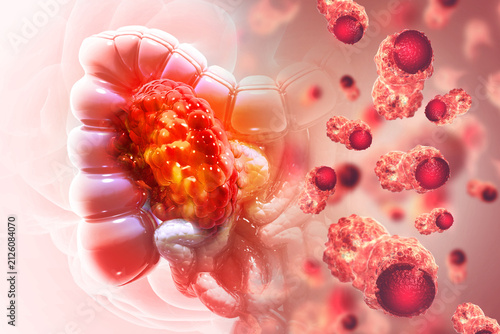 Colon cancer. Cancer attacking cell. Colon disease concept. 3d illustration