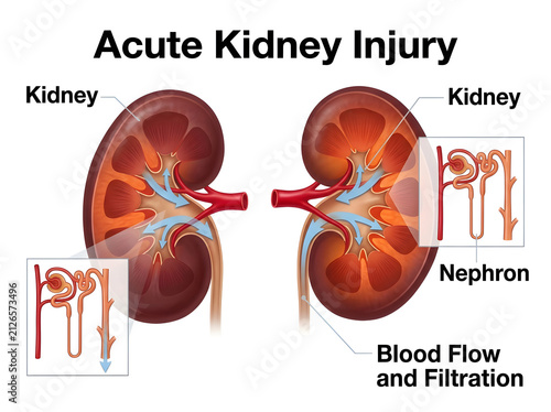 Acute kidney injury with nephron blood flow diagram isolated on white background