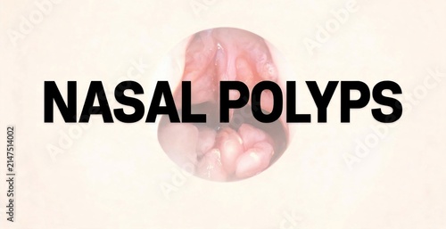 Graphic illustration of nasal polyps, a medical condition affecting the nasal cavity.