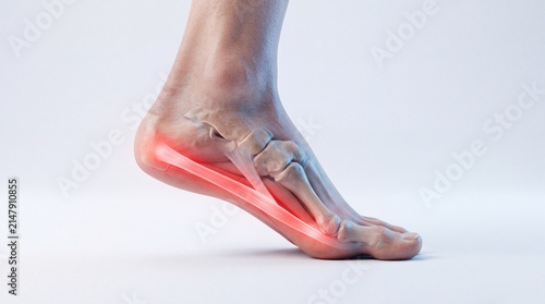 Plantar Fasciitis Anatomy with Inflamed Plantar Fascia Ligament and Heel Pain