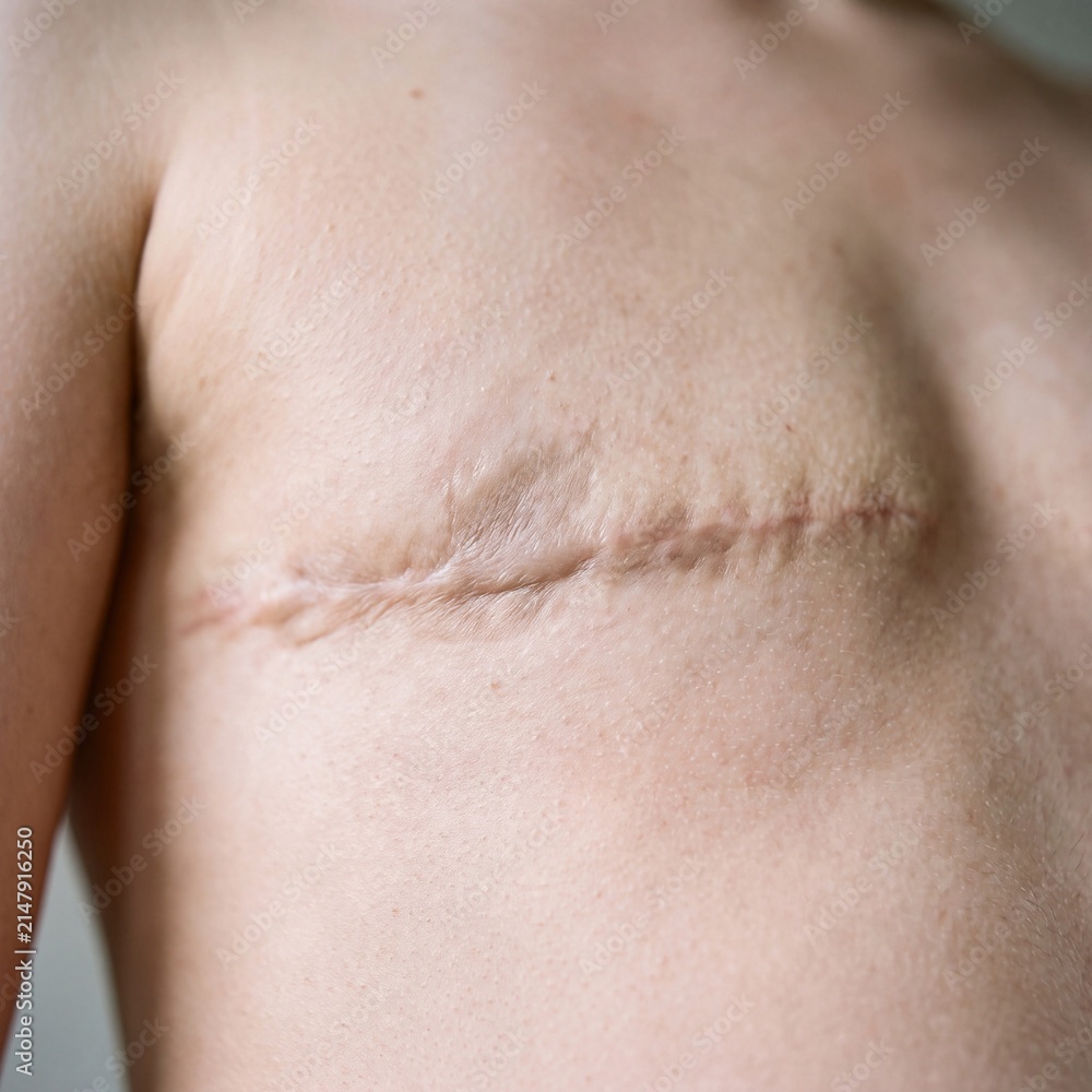 Fototapeta premium Macro view of healed surgical scar tissue on the chest skin area