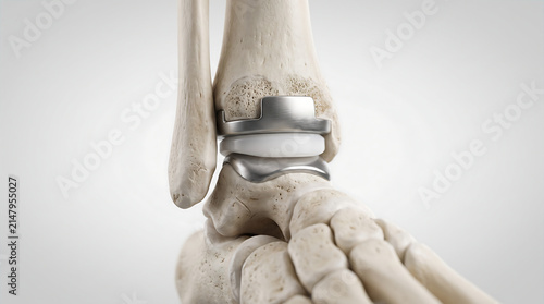 medical 3d illustration showing total ankle replacement surgery with titanium joint prosthesis component integrated into human foot bone structure for orthopedic healthcare treatment