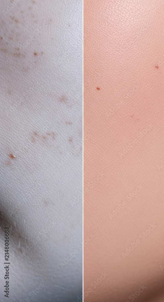 Fototapeta premium Close-up of skin texture, showing moles and pores, a representation of human biology and health