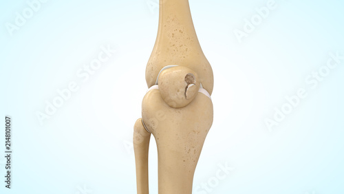 Osteochondral patella fracture of 3d illustration