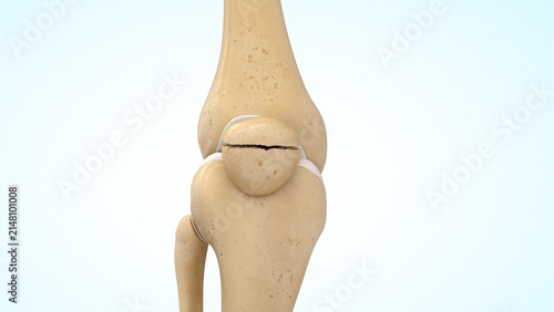 Transverse patella fracture of 3d illustration