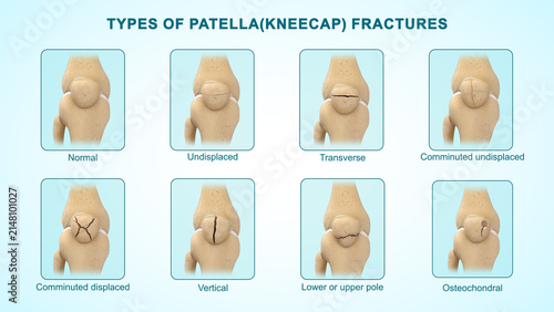 Types of patella(kneecap) fractures of 3d illustration