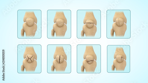 Types of patella(kneecap) fractures of 3d illustration