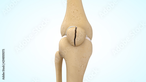 Vertical patella bone fracture of 3d illustration
