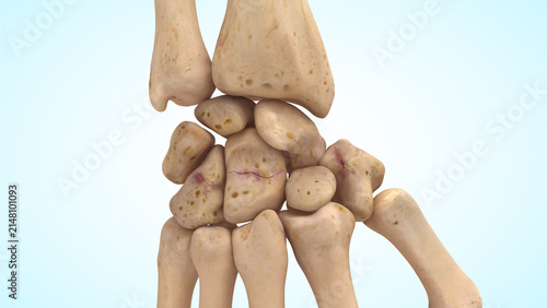 Carpal bones non displaced bone fracture fracture of 3d illustration