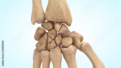 Displaced fracture of the wrist carpal bones 3d illustration